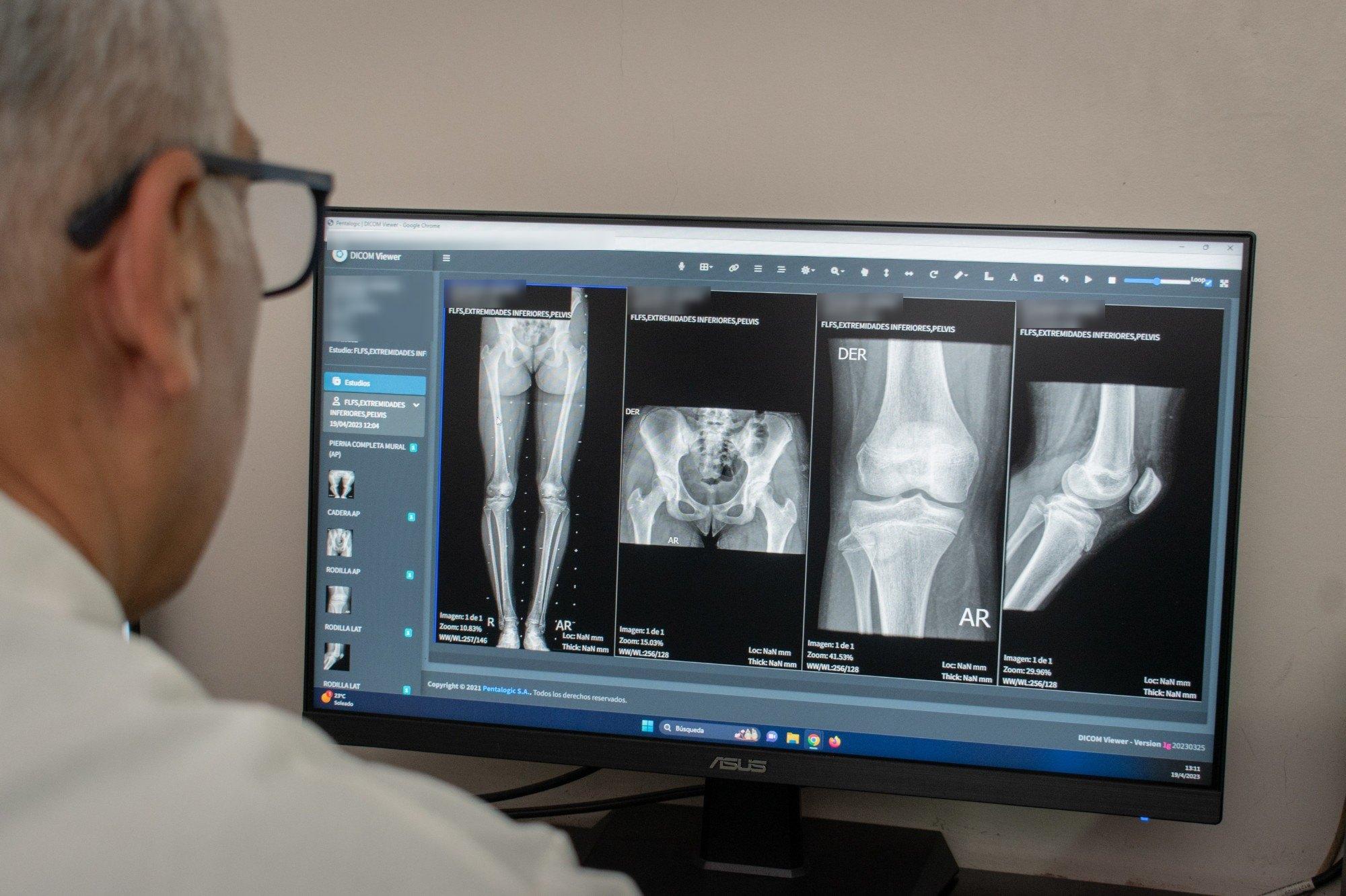Un médico revisa una radiografía de miembros inferiores en el visor DICOM de Pentalogic, en un centro de salud cliente. Los datos del paciente están difuminados.